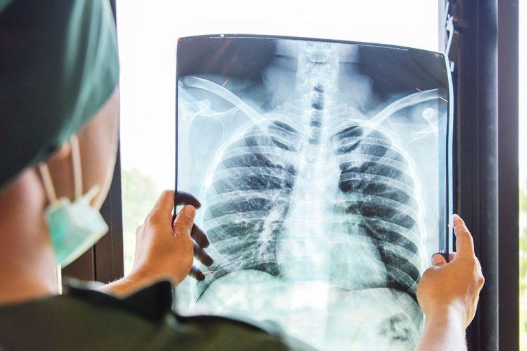 Major Warning Signs of Lung Cancer
